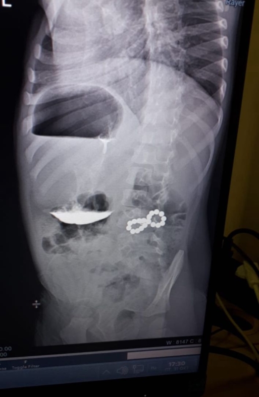 Ставропольские хирурги спасли трехлетнего мальчика, проглотившего 18 магнитов Ставропольские хирурги спасли трехлетнего мальчика, проглотившего 18 магнитов