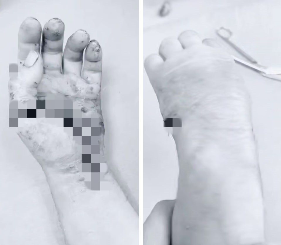 В Пятигорске врачи пришили пациенту отпиленную кисть